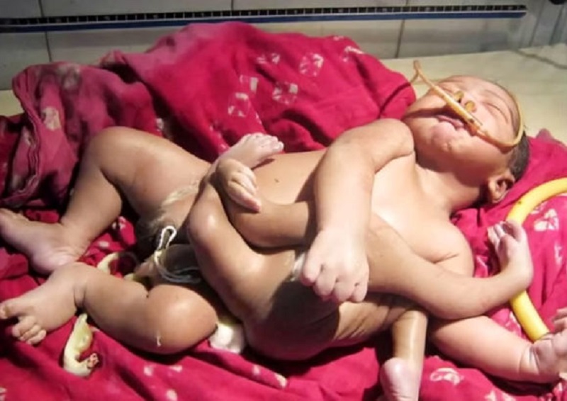 A Baby Born with 8 Limbs in India